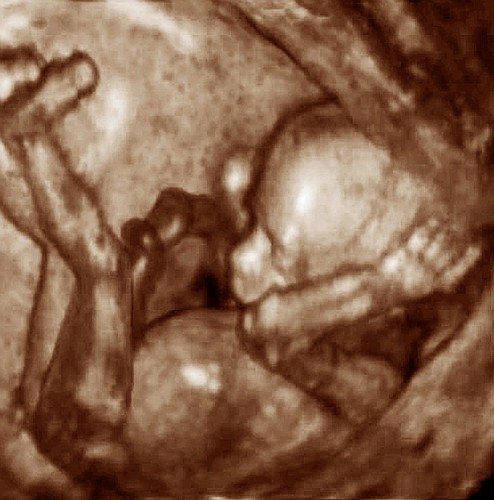 Foetal ultrasound. Three-dimensional (3-D) ultrasound scan of a human foetus. Its head is at centre right, its body at bottom centre, and its legs at far left. The umbilical cord is seen at centre left. The image was produced by a third generation 3-D ultrasound scanner called Voluson 730. 3-D scanning enables physiological disorders such as harelip and spina bifida to be diagnosed before birth. Ultrasound is a diagnostic technique which sends high-frequency sound waves into the body via a transducer. The returning echoes are recorded and used to build an image of an internal structure.