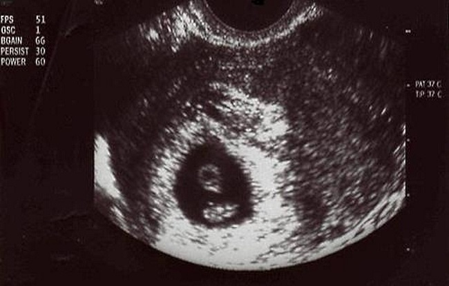 Как выглядит узи на 6 неделе. Плод на 6 неделе беременности УЗИ. УЗИ 6 недель беременности фото. Эмбрион на 6 неделе беременности УЗИ. Снимки УЗИ на 6 неделе беременности.