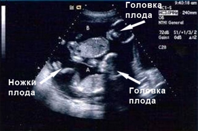 20 недель половина. УЗИ двойни на 20 неделе беременности. УЗИ 19 недель беременности двойня. 20 Недель беременности двойней размер плода.