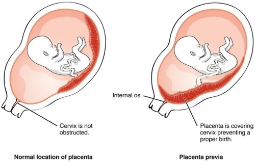 Низкая плацентация на ранних сроках беременности thumbnail