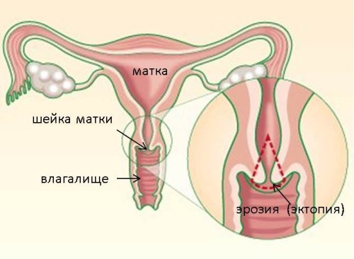 Как протекает беременность при эрозии шейки матки thumbnail