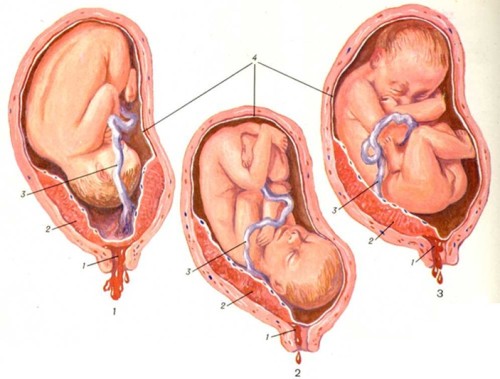 Что такое двурогая матка при беременности thumbnail