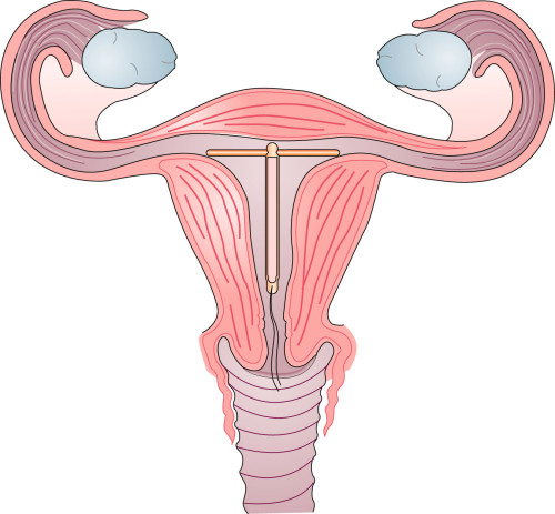 Беременность со спиралью последствия для ребенка фото thumbnail