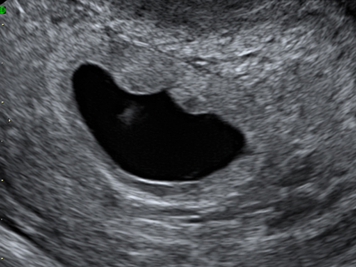 Гематома 6 недель. Ретрохориальная гематома беременность. УЗИ 6 недель беременности отслойка плодного яйца.