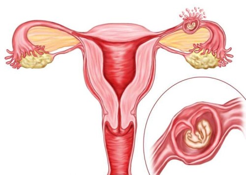 Боли внизу живота яичники при беременности на ранних сроках thumbnail