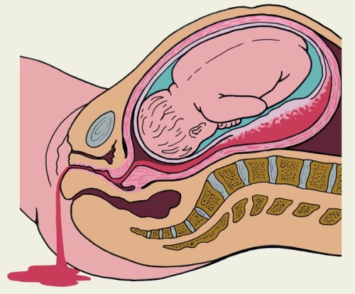 Гематома матки при беременности на ранних сроках прогноз thumbnail