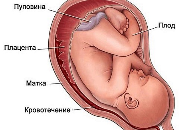 22 неделе плацента. Ретроплацентарная гематома. Гемотон при беременности. Ретрохориальная гематома в матке. Гематома при беременности.