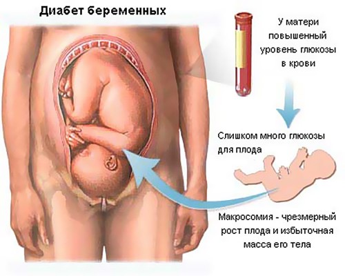 Глюкозотолерантный тест при беременности как подготовиться thumbnail