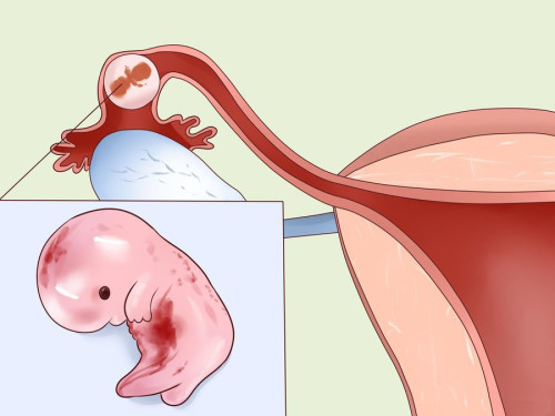 внематочная-беременность-операция