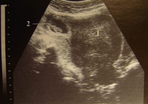 Определить внематочную беременность на каком сроке thumbnail
