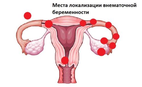 Тянущая боль в правом боку внизу живота у женщины при беременности thumbnail