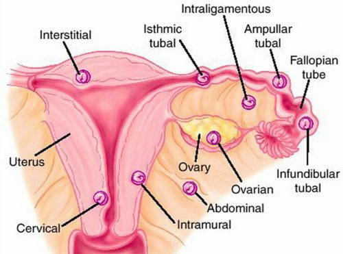 Определить внематочную беременность на каком сроке