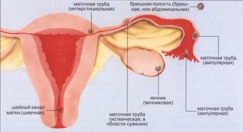 На каком сроке можно определить внематочную беременность thumbnail