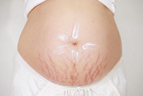 Чтобы не было растяжек во время беременности на животе thumbnail