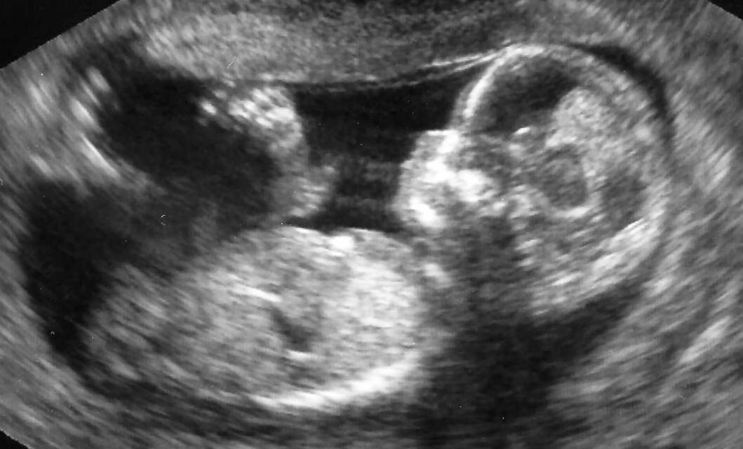 12 недель и 2 дня. УЗИ 12 недель беременности УЗИ скрининг. Эмбрион на 12 неделе беременности УЗИ. УЗИ на 13 неделе беременности скрининг. УЗИ на 11-12 неделе беременности скрининг.
