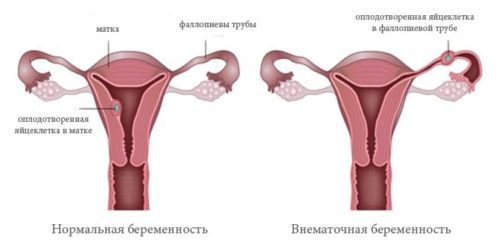 Диагностика внематочной беременности на ранних сроках