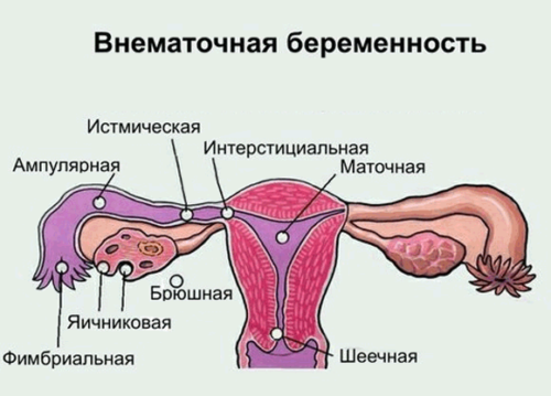 Диагностика внематочной беременности на ранних сроках