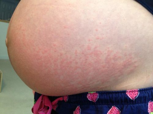 Аллергия при беременности крапивница на руках