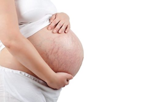 Средства от растяжек в домашних условиях при беременности