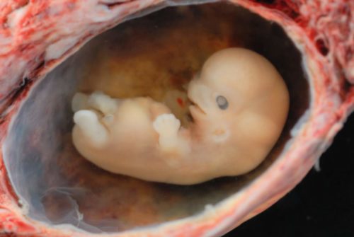 Может ли при замершей беременности продолжаться токсикоз