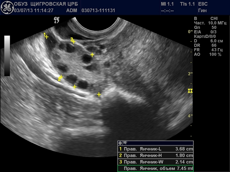Желтое тело в левом яичнике при беременности что это значит thumbnail