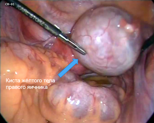 Желтое тело в яичнике при беременности