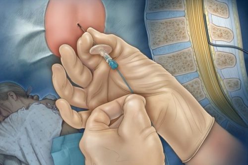 Эпидуральная анестезия в родах показания и противопоказания