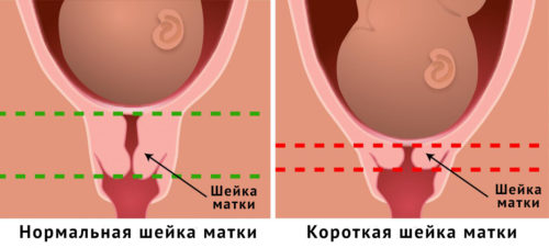 Длина шейки матки по неделям беременности