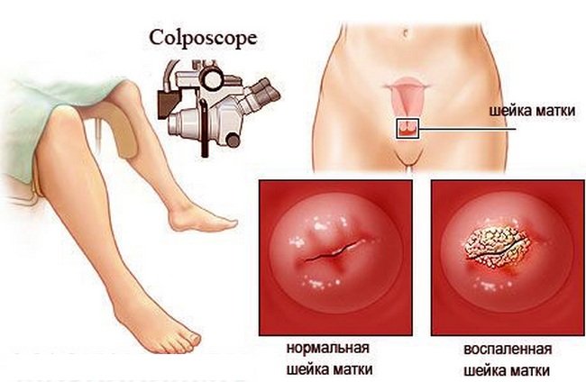 Кольпоскопия что это за процедура в гинекологии во время беременности thumbnail