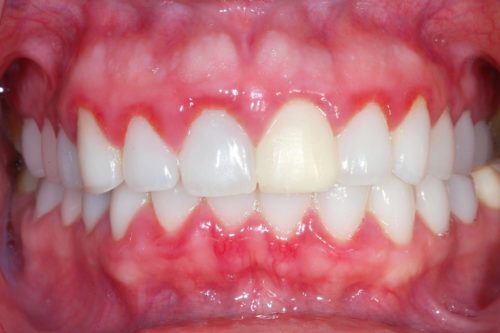 Воспаление десны около зуба лечение у беременных