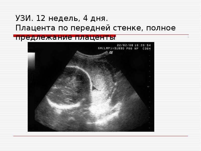 Где находится плацента при беременности фото