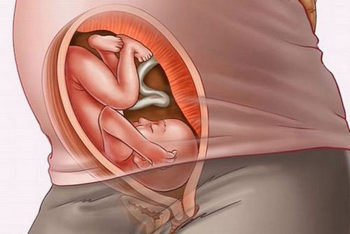 Утолщение плаценты при беременности 20 недель лечение