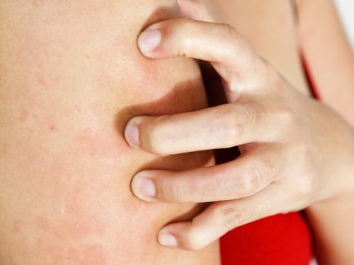 Аллергия мелкая сыпь при беременности