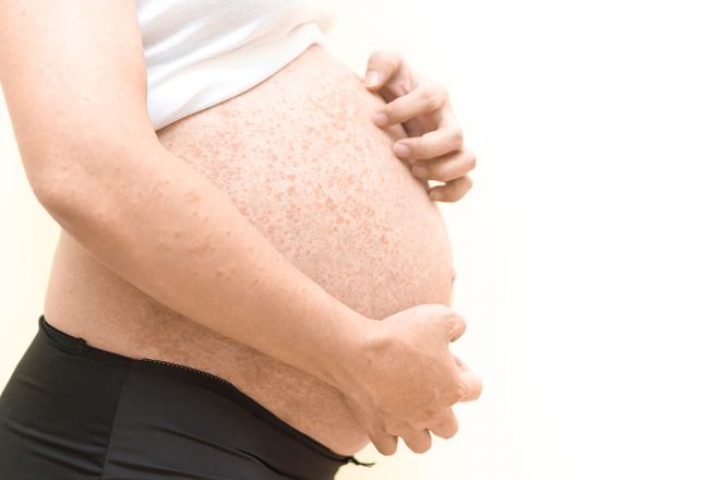 Сыпь при беременности на ранних и поздних сроках. Лечение сыпи во время беременности