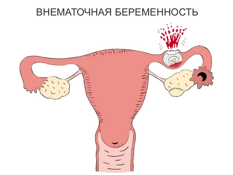 Можно ли забеременеть после внематочной беременности с одной трубой левой