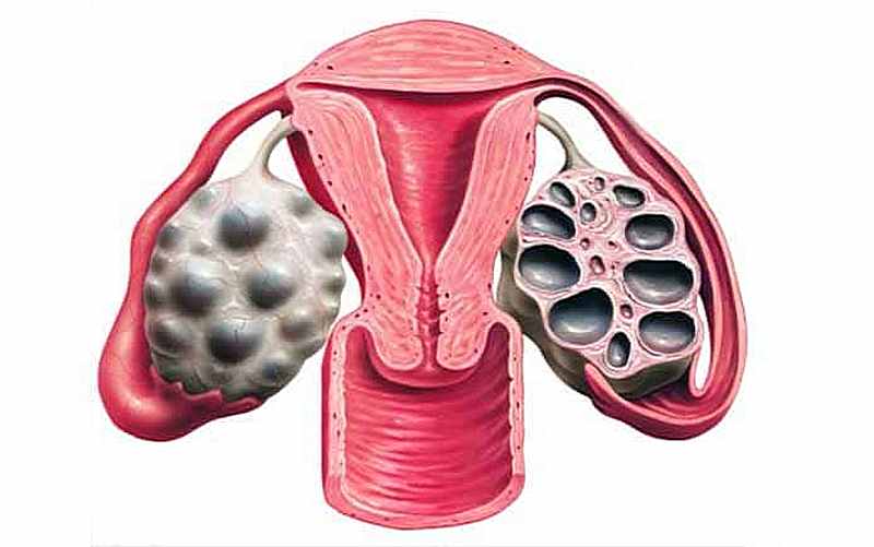 Мультифолликулярные яичники и беременность — можно ли забеременеть? Мультифолликулярные яичники и многоплодная беременность