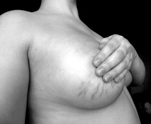 Крем от растяжек на груди при беременности