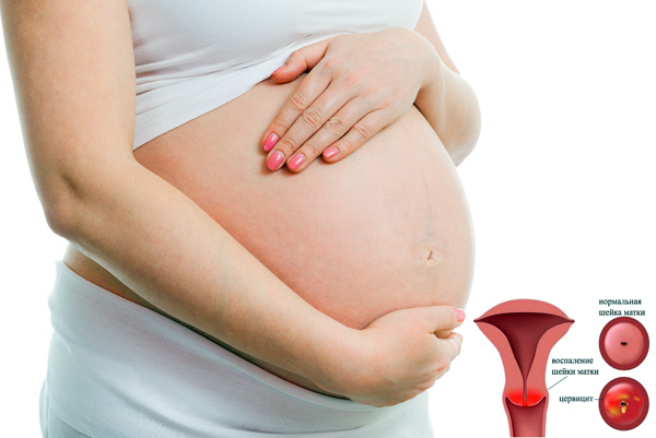 Цервицит шейки матки при беременности: причины, симптомы, диагностика. Лечение цервицита во время беременности