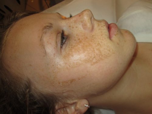 Шелушение кожи на лице при беременности
