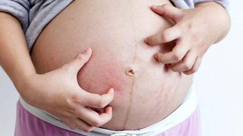 зуд кожи лица при беременности