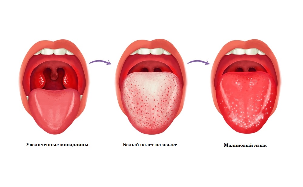 Причины налета на языке при беременности. Почему немеет, болит, трескается язык во время беременности — диагностика, лечение