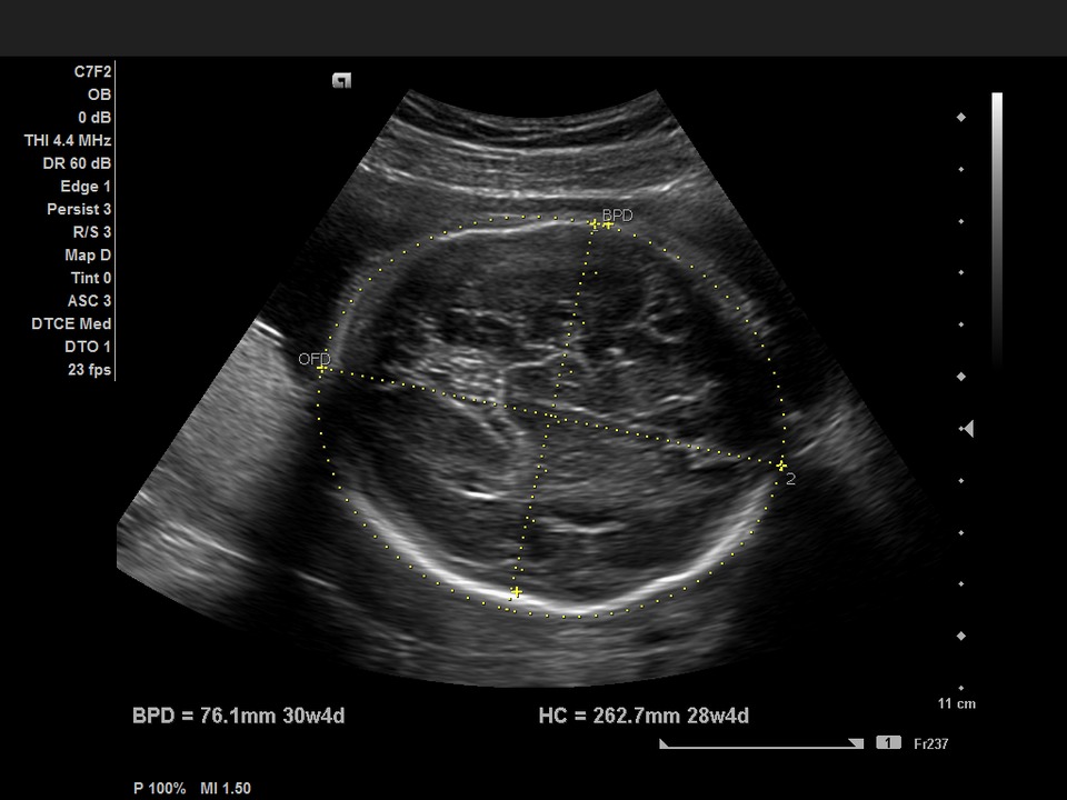 Доверие узи. Измерение БПР на УЗИ. Бипариетальный размер головки плода по УЗИ. БПР УЗИ беременность. Ультразвуковое исследование при беременности-БПР.