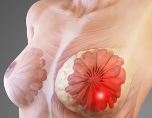 Болит ли грудь во время беременности при мастопатии