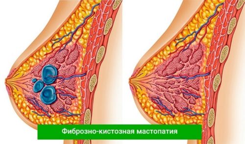Признаки мастопатии или грудь болит при беременности