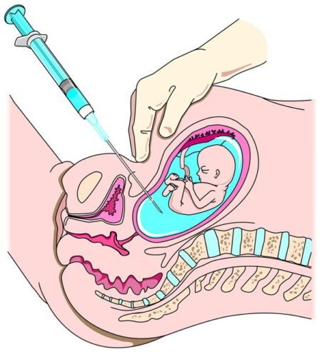 Как называется прокол живота во время беременности