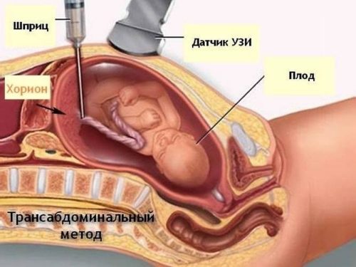 Как называется прокол живота во время беременности thumbnail