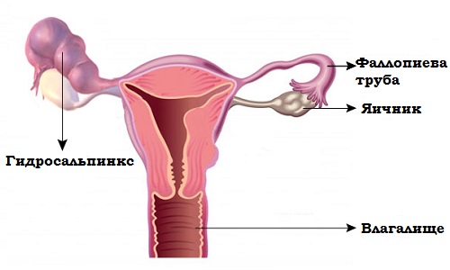 Возможна ли беременность при гидросальпинксе. Как гидросальпинкс влияет на беременность. Вероятность беременности после гидросальпинкса