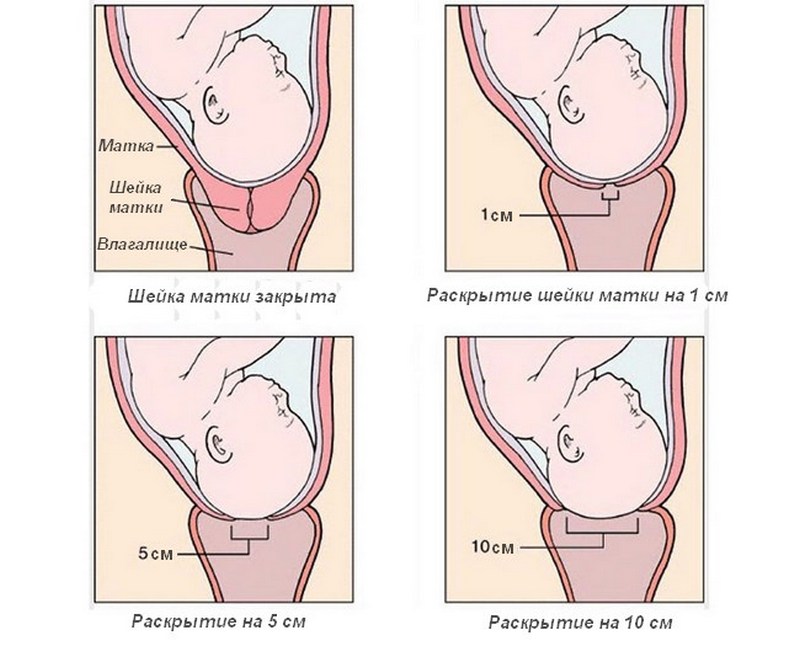 Удлиненная матка при беременности. Раскрытие шейки матки при родах. Раскрытая шейка матки перед родами. Раскрытие шейки матки при родах периоды. Раскрытие шейки матки при беременности.