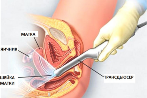 Как делают узи матки при беременности