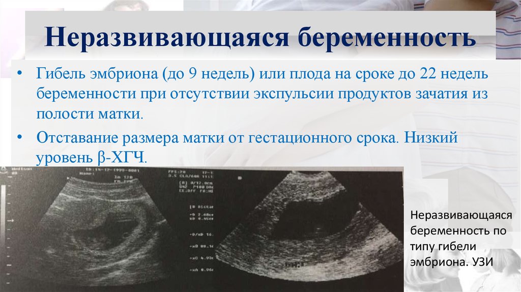 Прояви беременности. УЗИ признаки неразвивающейся беременности. Вымершая беременности. Не развивающая беременность.